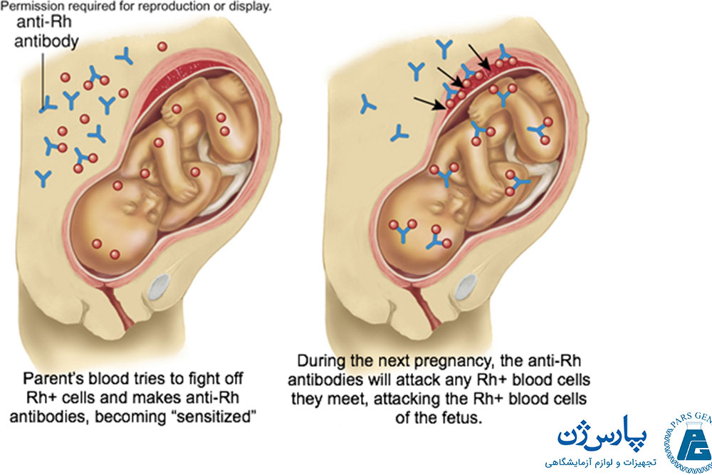  تفاوت RhD مادر و جنین